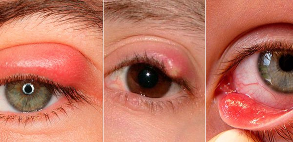 Ячмень на глазу – причины, симптомы и лечение в домашних условиях